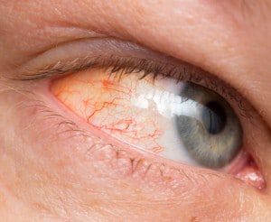 Chronic conjunctivitis eye